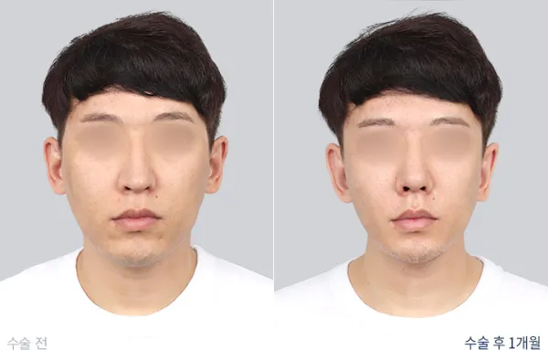Before/After