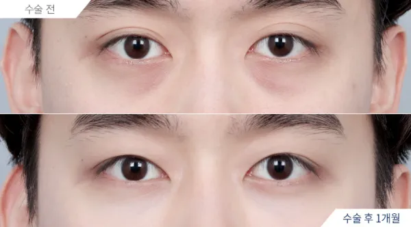 Before/After