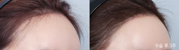 Before/After