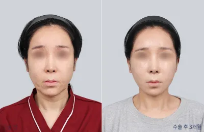 Before & After
