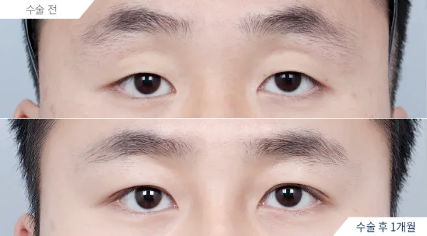 Before/After