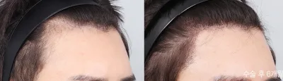Before & After