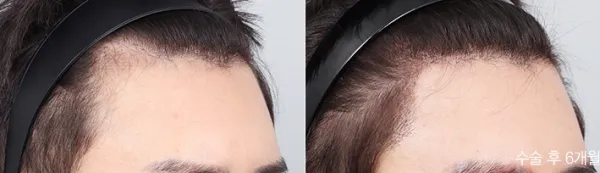 Before/After