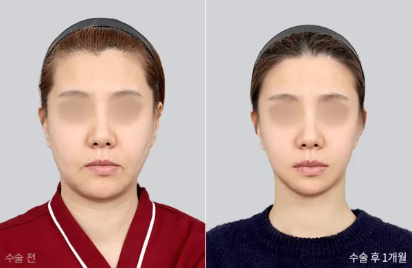 Before/After