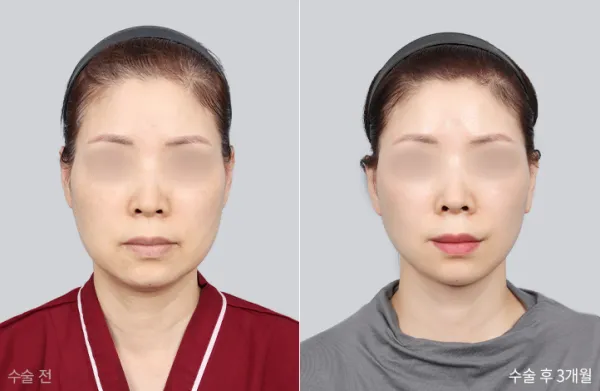 Before/After