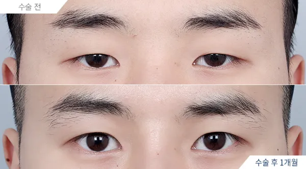 Before/After
