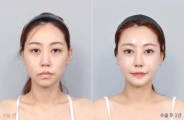 Before/After