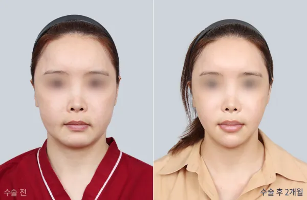 Before/After