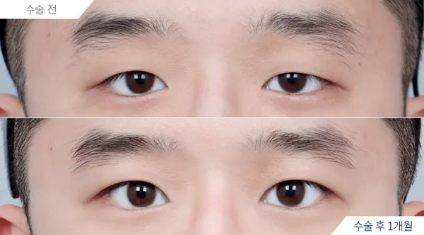 Before/After
