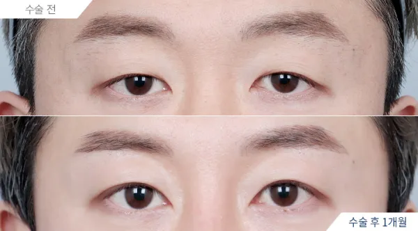 Before/After