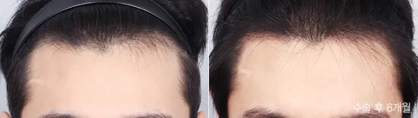 Before/After