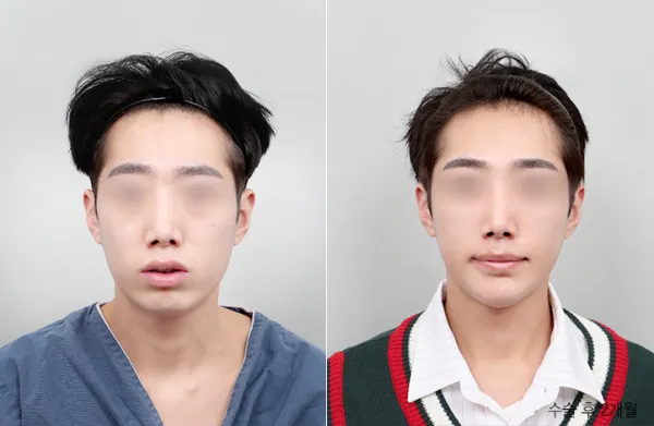 Before/After