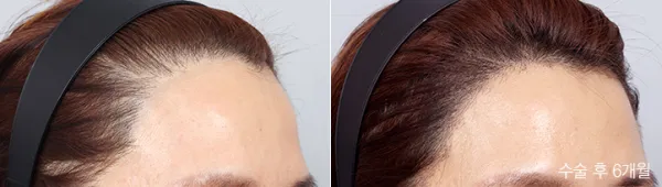 Before/After