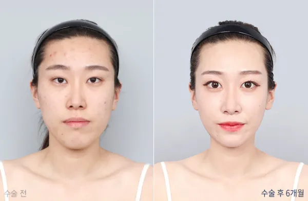 Before/After