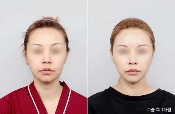 Before/After