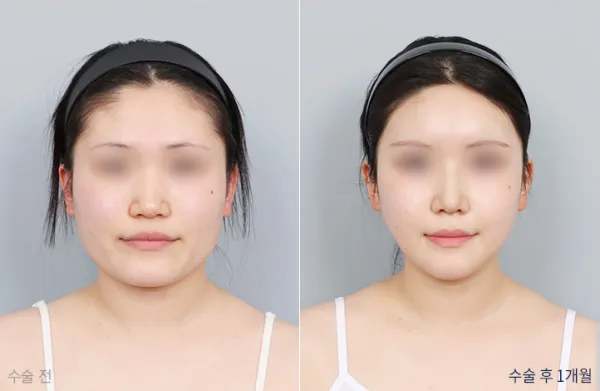 Before/After