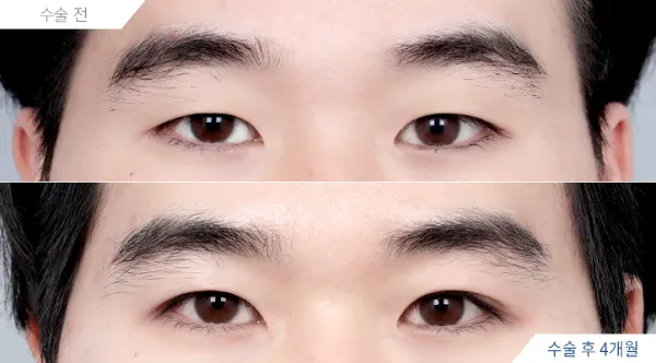 Before/After