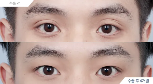 Before/After