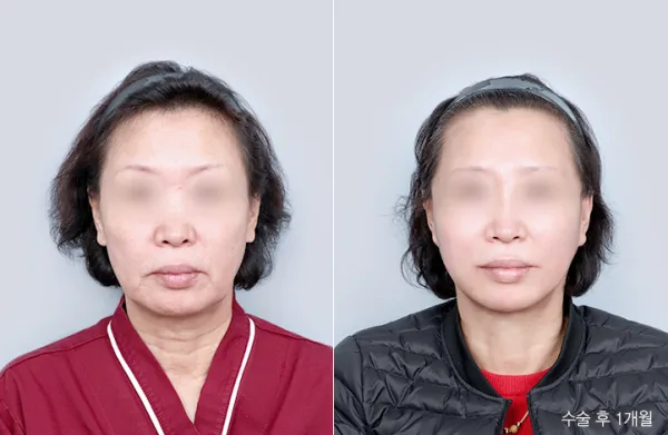 Before/After