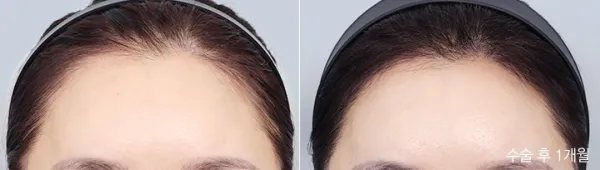Before/After