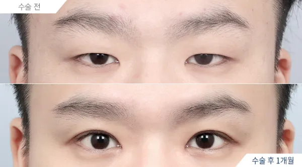 Before/After