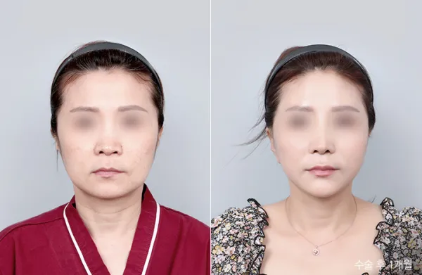 Before/After