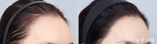 Before/After