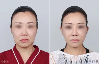 Before & After