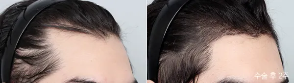 Before/After
