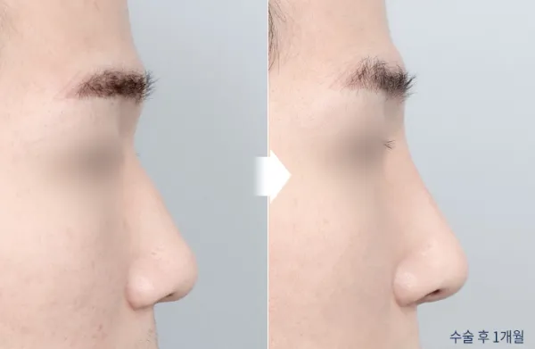 Before/After