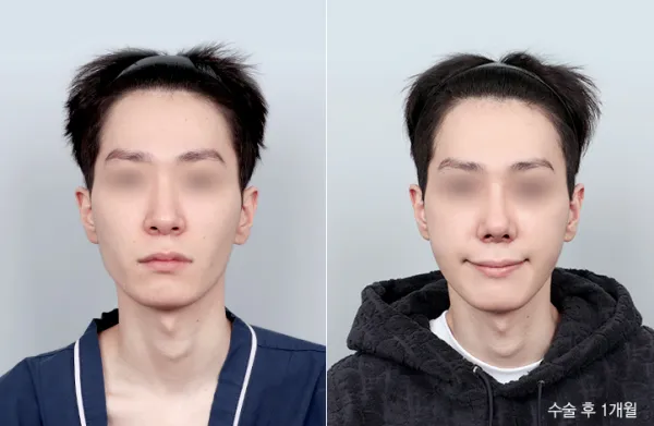 Before/After