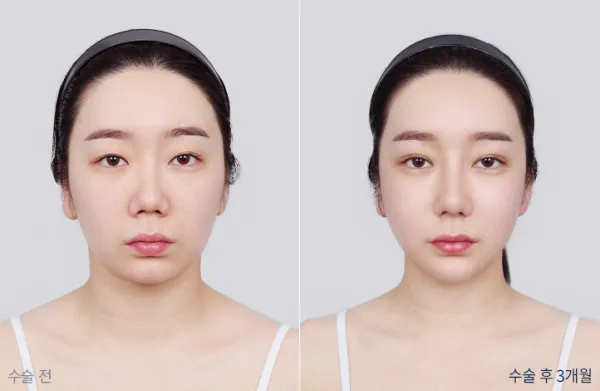 Before/After