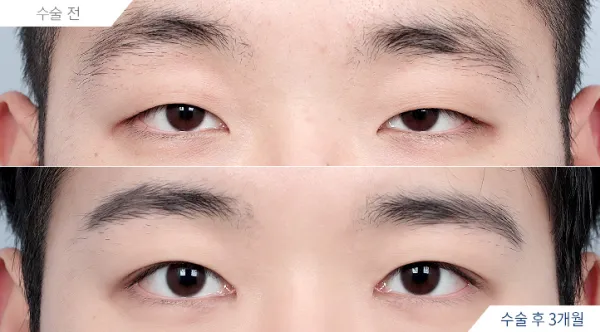 Before/After