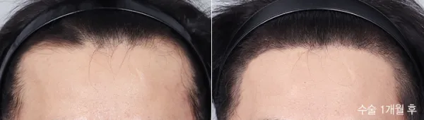Before/After