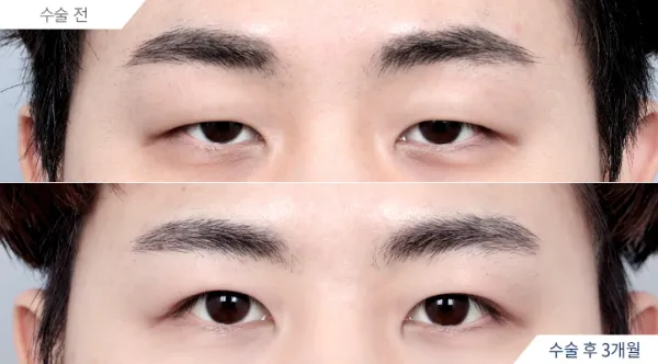 Before/After