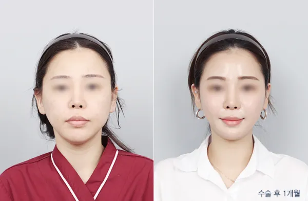 Before/After