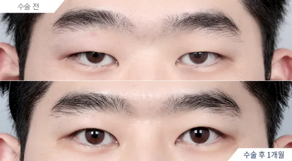 Before/After