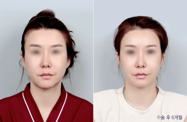 Before/After