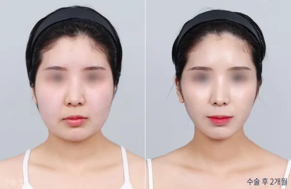 Before/After