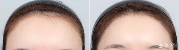 Before/After