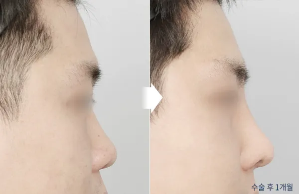 Before/After