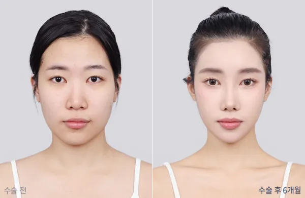 Before/After