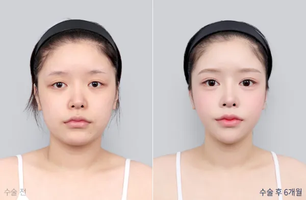 Before/After