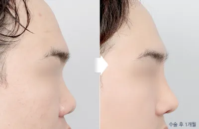 Before & After