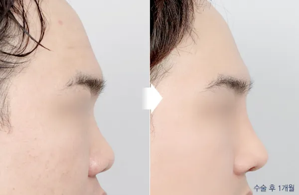 Before/After