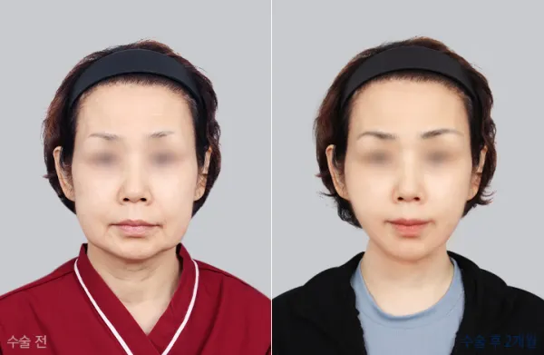 Before/After