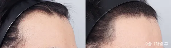 Before/After