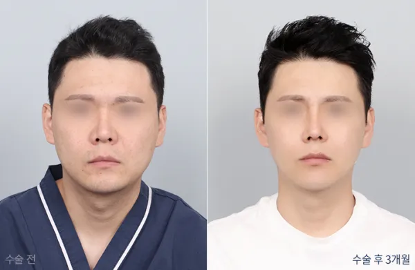 Before/After