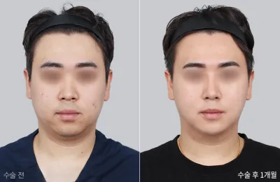 Before & After