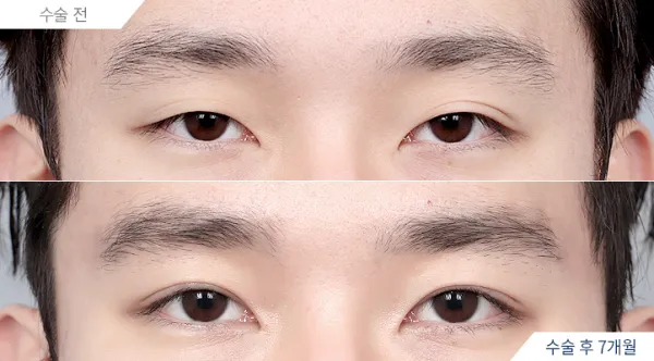 Before/After